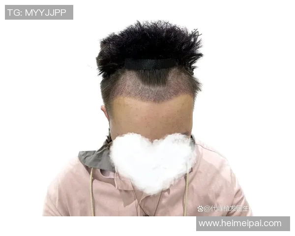 土耳其植发技术助力足球明星重塑自信与风采 土耳其植发技术助力足球明星重塑自信与风采